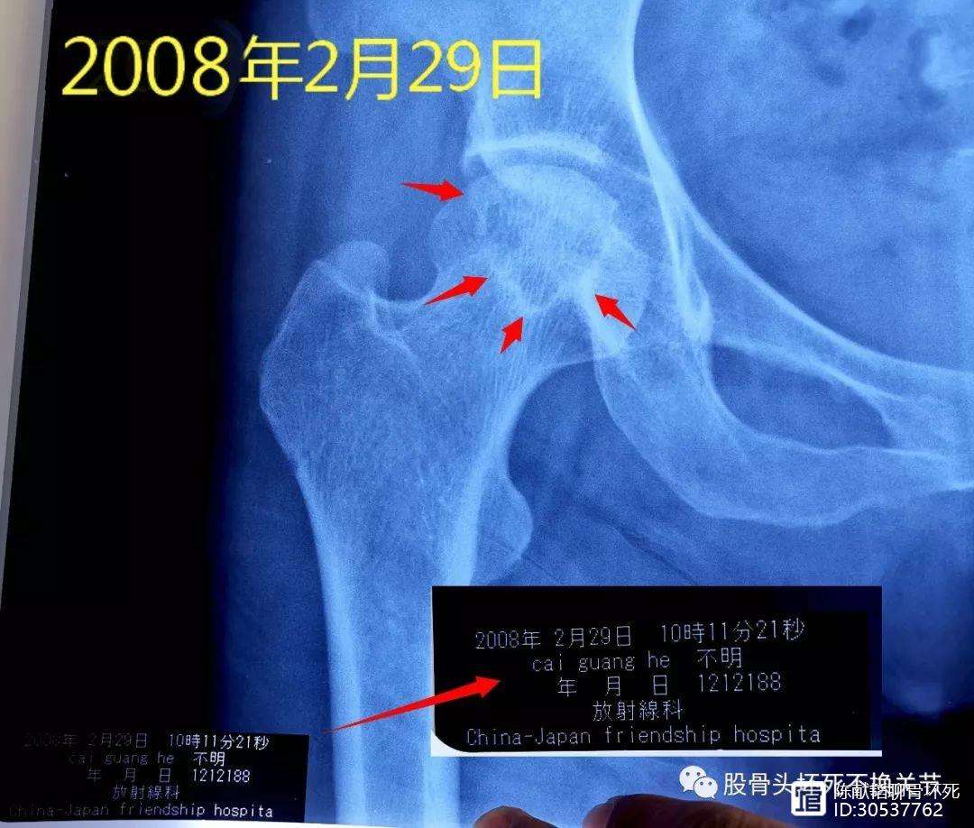 镇江人工骨头医保报销多少(人工骨头医保报销多少比例)